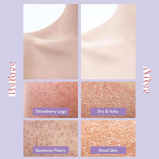 Toi:L Gentle Touch Bubble Peeling Body Pad(5pads), Body Scrub, Exfoliating Mitt for Body, Exfoliating Gloves, washcloth, Body loofah, Dense Bubble Bath, Bath Shower, kp Bump Eraser